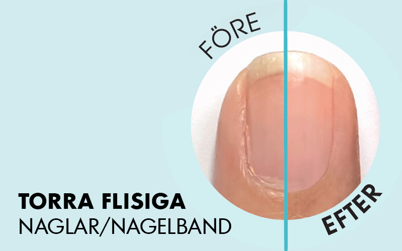 Torra flisiga naglar o nagelband